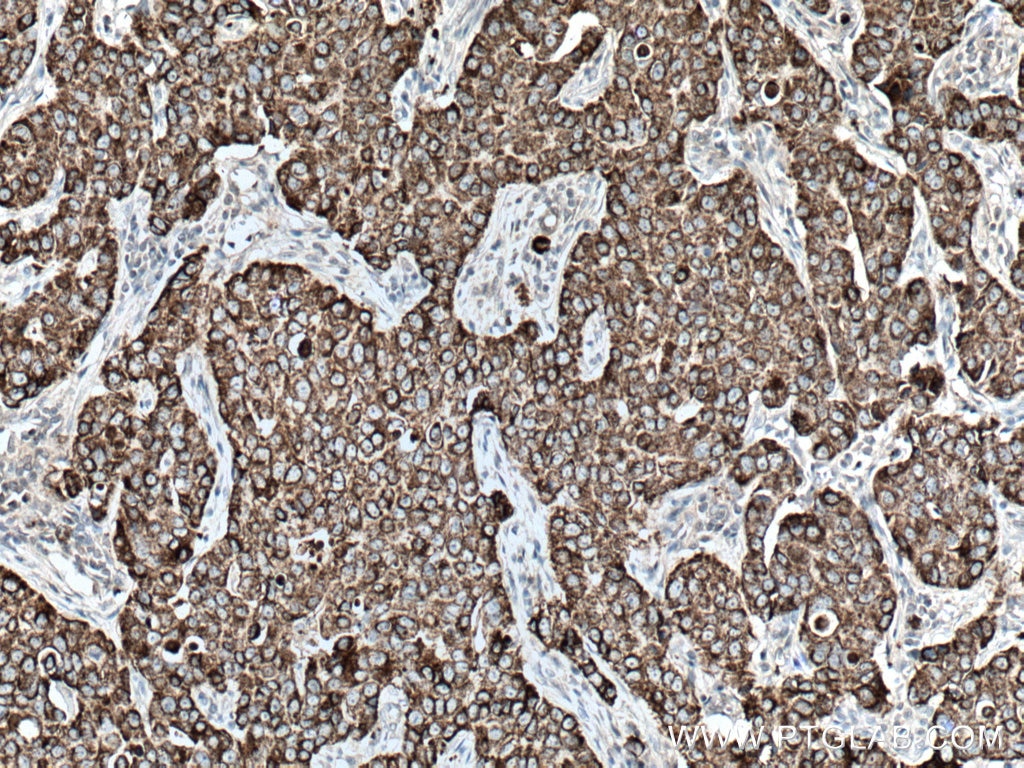 Immunohistochemistry (IHC) staining of human breast cancer tissue using CKMT1A Polyclonal antibody (15346-1-AP)