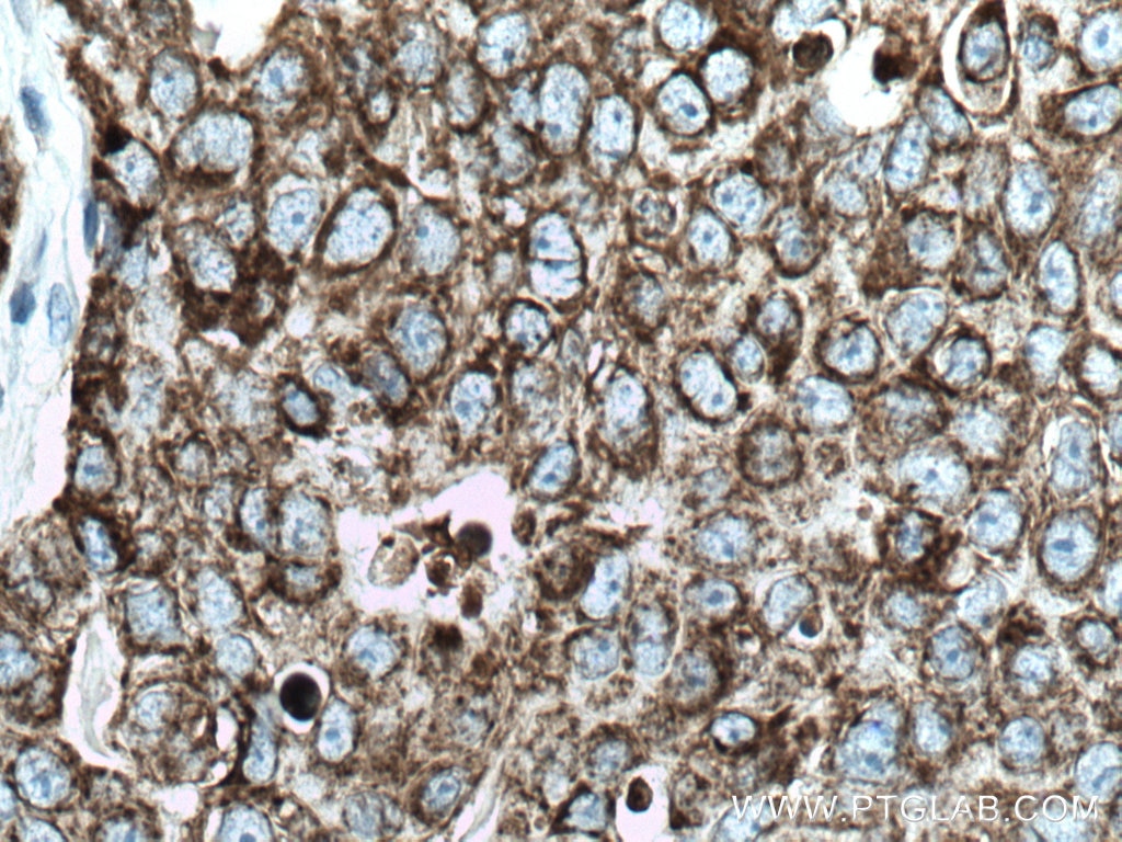 Immunohistochemistry (IHC) staining of human breast cancer tissue using CKMT1A Polyclonal antibody (15346-1-AP)