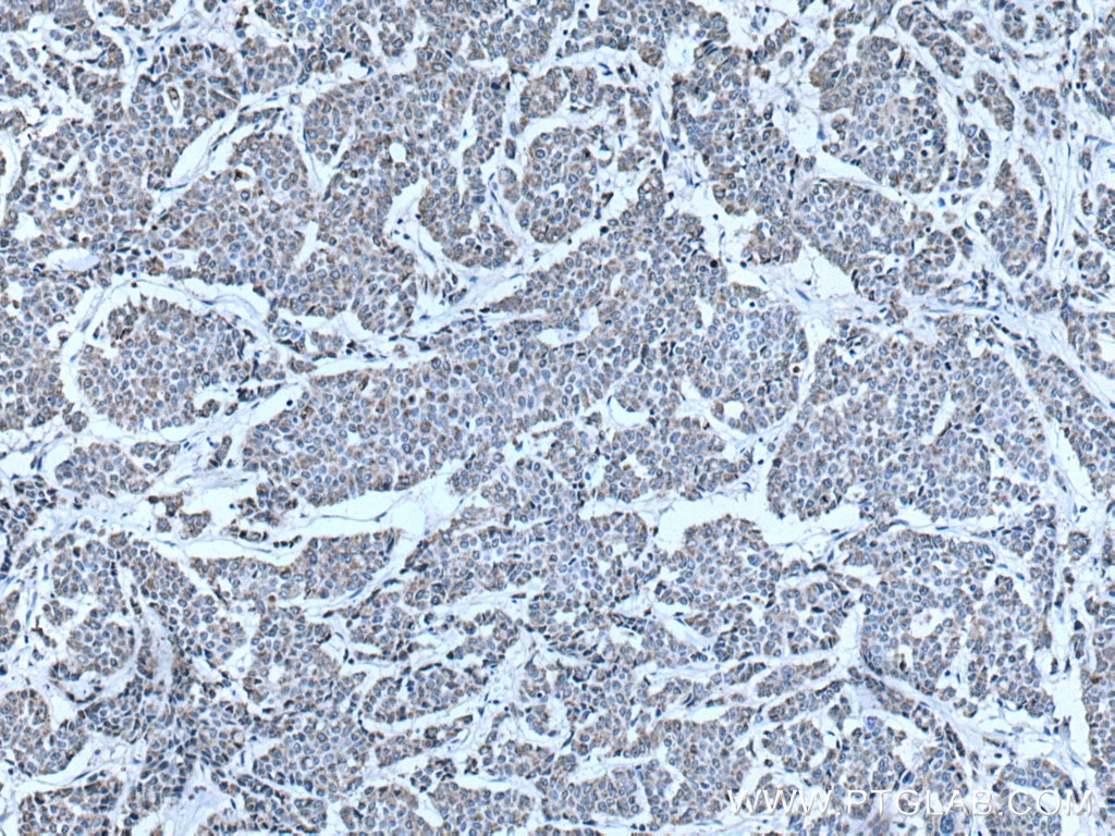 Immunohistochemistry (IHC) staining of human colon cancer tissue using CKMT1A Polyclonal antibody (15346-1-AP)