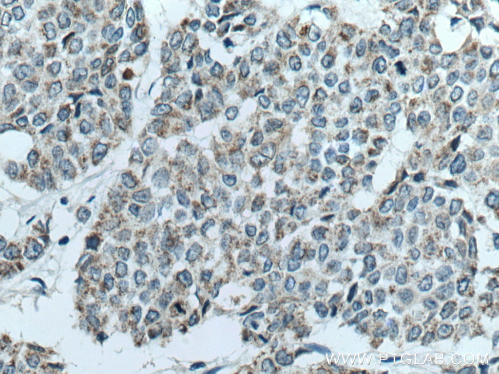Immunohistochemistry (IHC) staining of human colon cancer tissue using CKMT1A Polyclonal antibody (15346-1-AP)