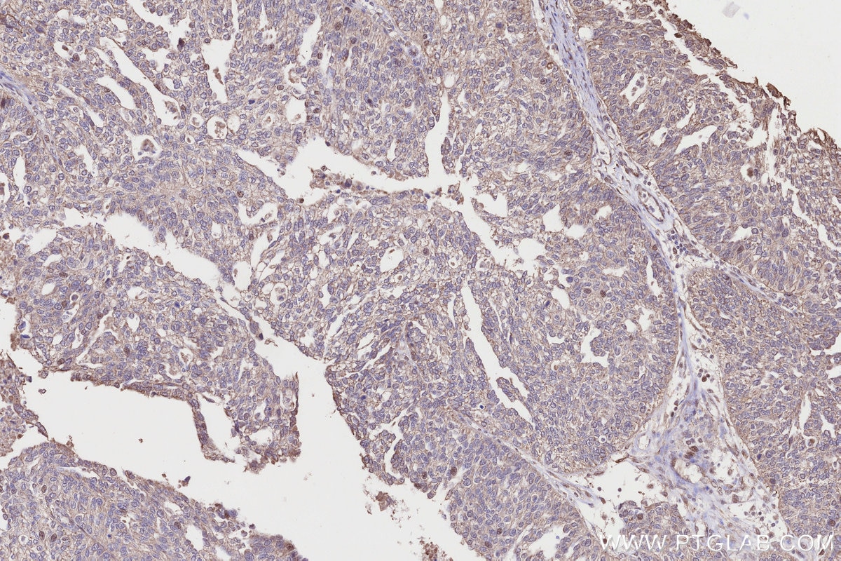 Immunohistochemistry (IHC) staining of human ovary cancer tissue using CLCN3 Polyclonal antibody (55330-1-AP)