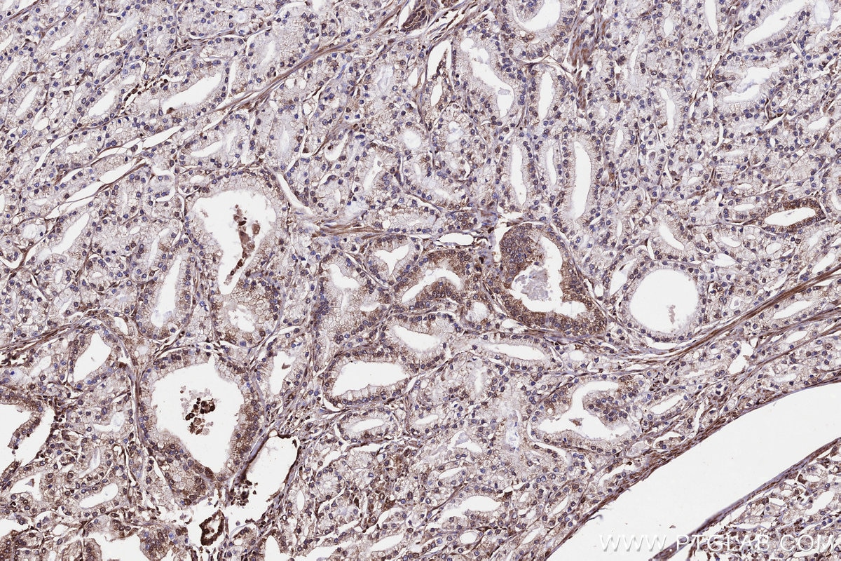 IHC staining of human prostate cancer using 29230-1-AP (same clone as 29230-1-PBS) Immunohistochemistry (IHC) staining of human prostate cancer tissue using CLCN7 Polyclonal antibody (29230-1-AP)