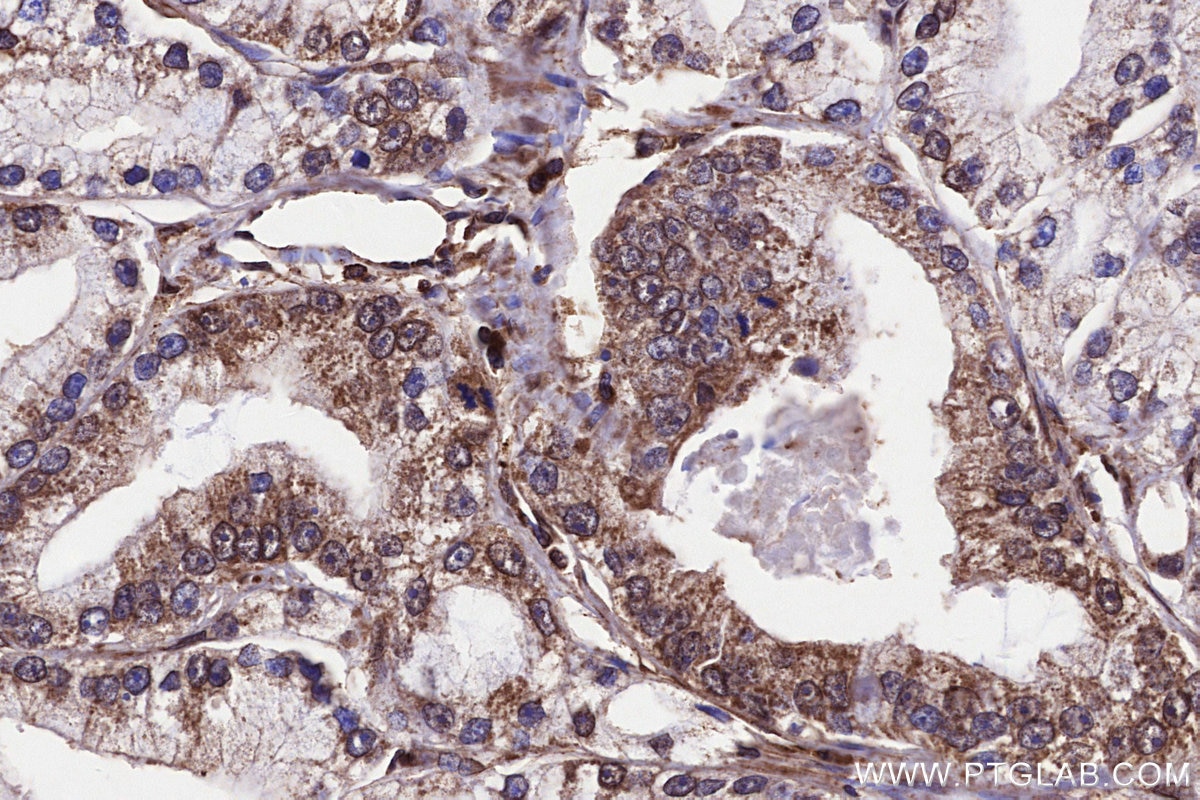 IHC staining of human prostate cancer using 29230-1-AP (same clone as 29230-1-PBS) Immunohistochemistry (IHC) staining of human prostate cancer tissue using CLCN7 Polyclonal antibody (29230-1-AP)