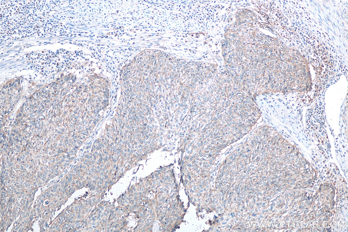 Immunohistochemistry (IHC) staining of human cervical cancer tissue using Claudin 1 Polyclonal antibody (13050-1-AP)