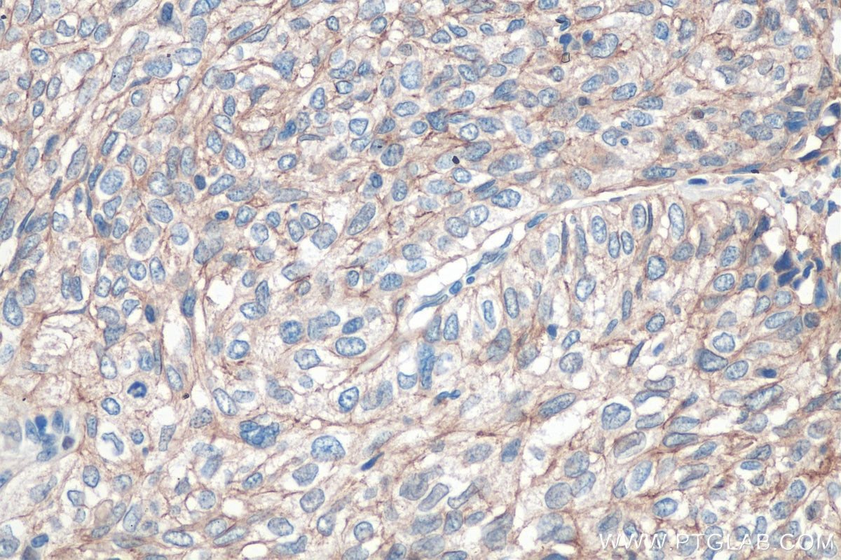 Immunohistochemistry (IHC) staining of human cervical cancer tissue using Claudin 1 Polyclonal antibody (13050-1-AP)