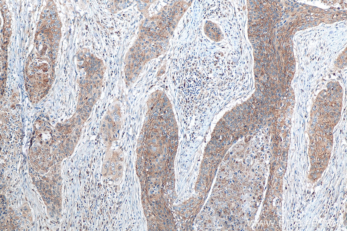 Immunohistochemistry (IHC) staining of human oesophagus cancer tissue using Claudin 1 Polyclonal antibody (13050-1-AP)