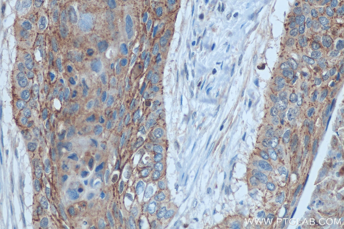 Immunohistochemistry (IHC) staining of human oesophagus cancer tissue using Claudin 1 Polyclonal antibody (13050-1-AP)