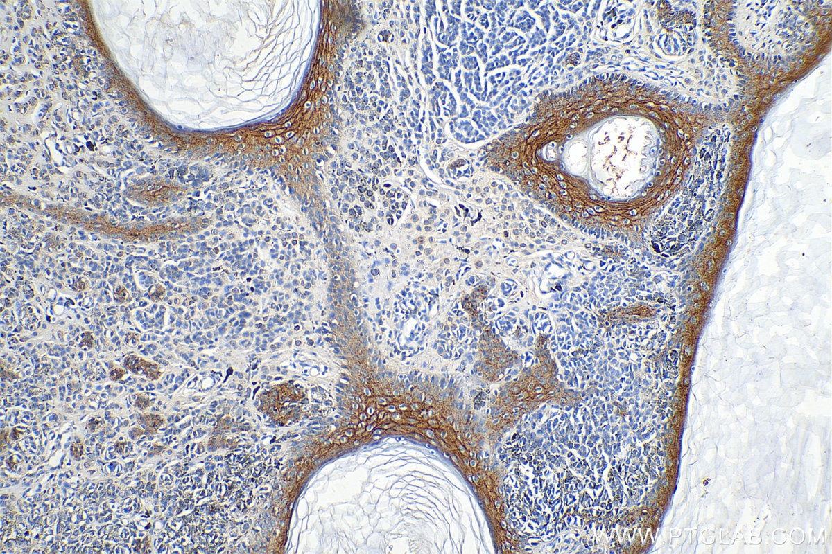 Immunohistochemistry (IHC) staining of human malignant melanoma tissue using Claudin 1 Polyclonal antibody (13050-1-AP)