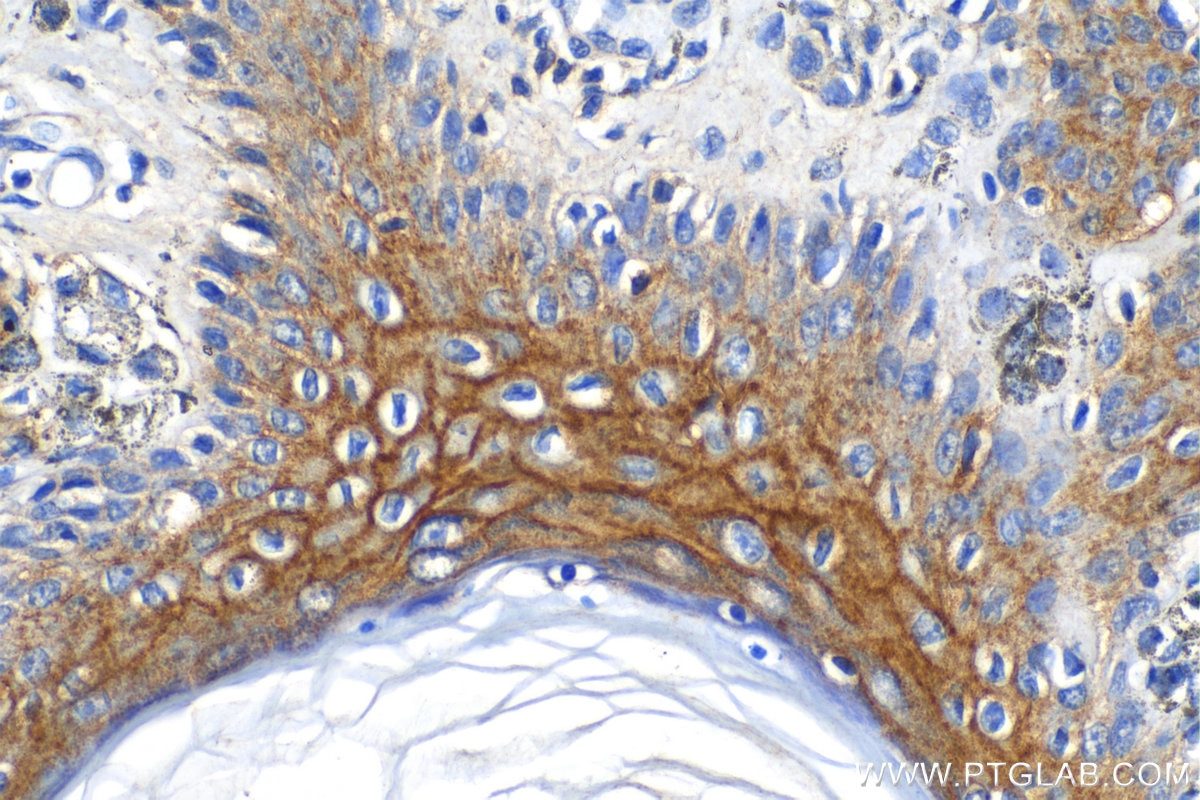 Immunohistochemistry (IHC) staining of human malignant melanoma tissue using Claudin 1 Polyclonal antibody (13050-1-AP)