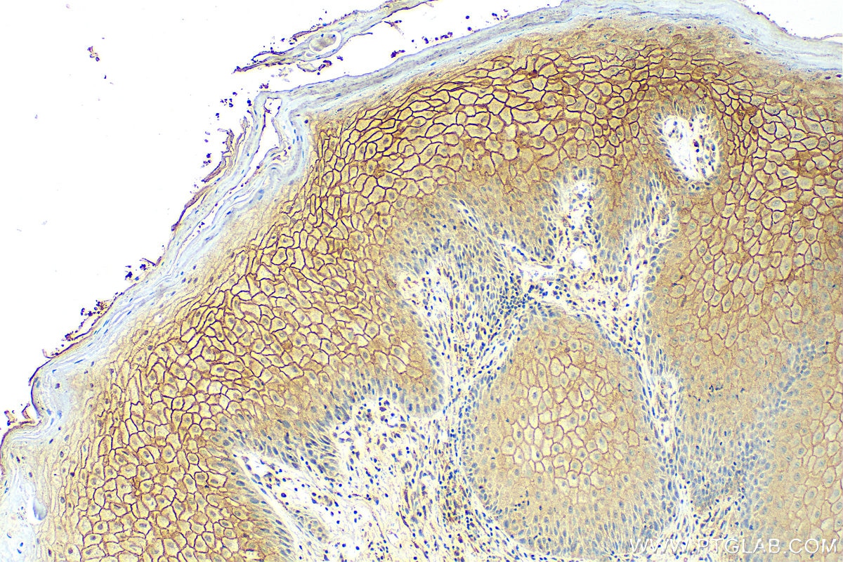 IHC staining of human skin cancer using 13050-1-AP