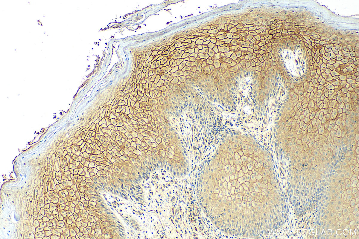 Immunohistochemistry (IHC) staining of human skin cancer tissue using Claudin 1 Polyclonal antibody (13050-1-AP)