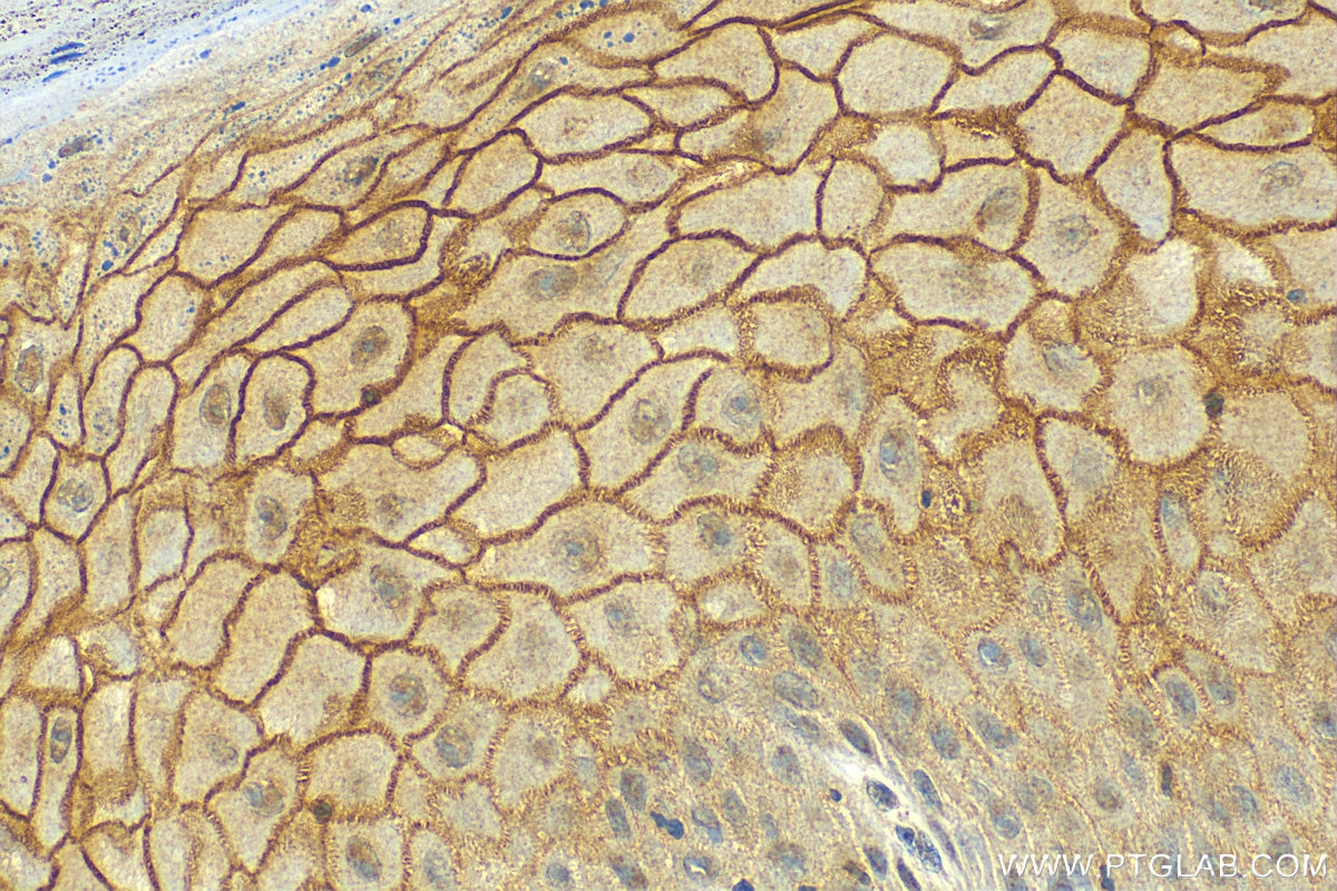 Immunohistochemistry (IHC) staining of human skin cancer tissue using Claudin 1 Polyclonal antibody (13050-1-AP)