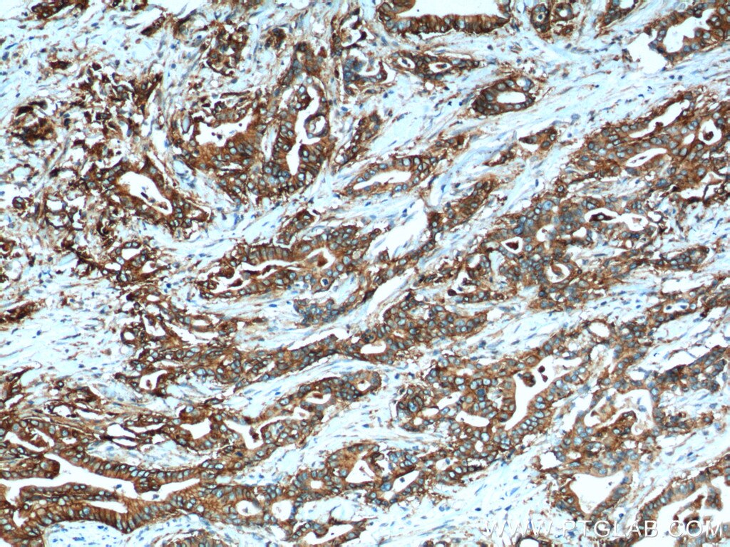 Immunohistochemistry (IHC) staining of human pancreas cancer tissue using Claudin 18 Polyclonal antibody (21126-1-AP)