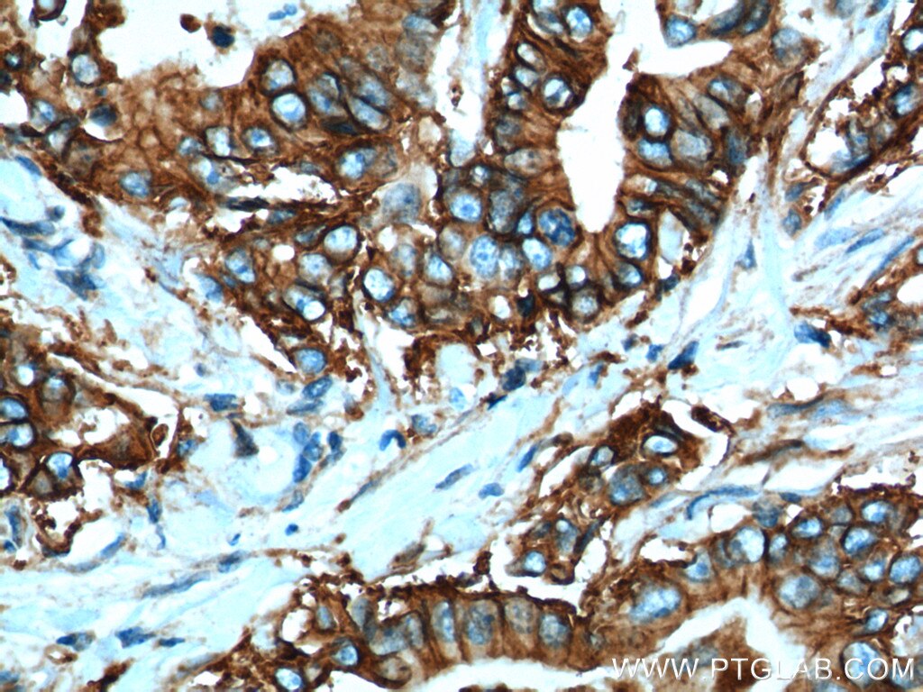 Immunohistochemistry (IHC) staining of human pancreas cancer tissue using Claudin 18 Polyclonal antibody (21126-1-AP)