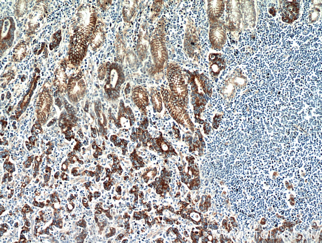 Immunohistochemistry (IHC) staining of human stomach cancer tissue using Claudin 18 Polyclonal antibody (21126-1-AP)