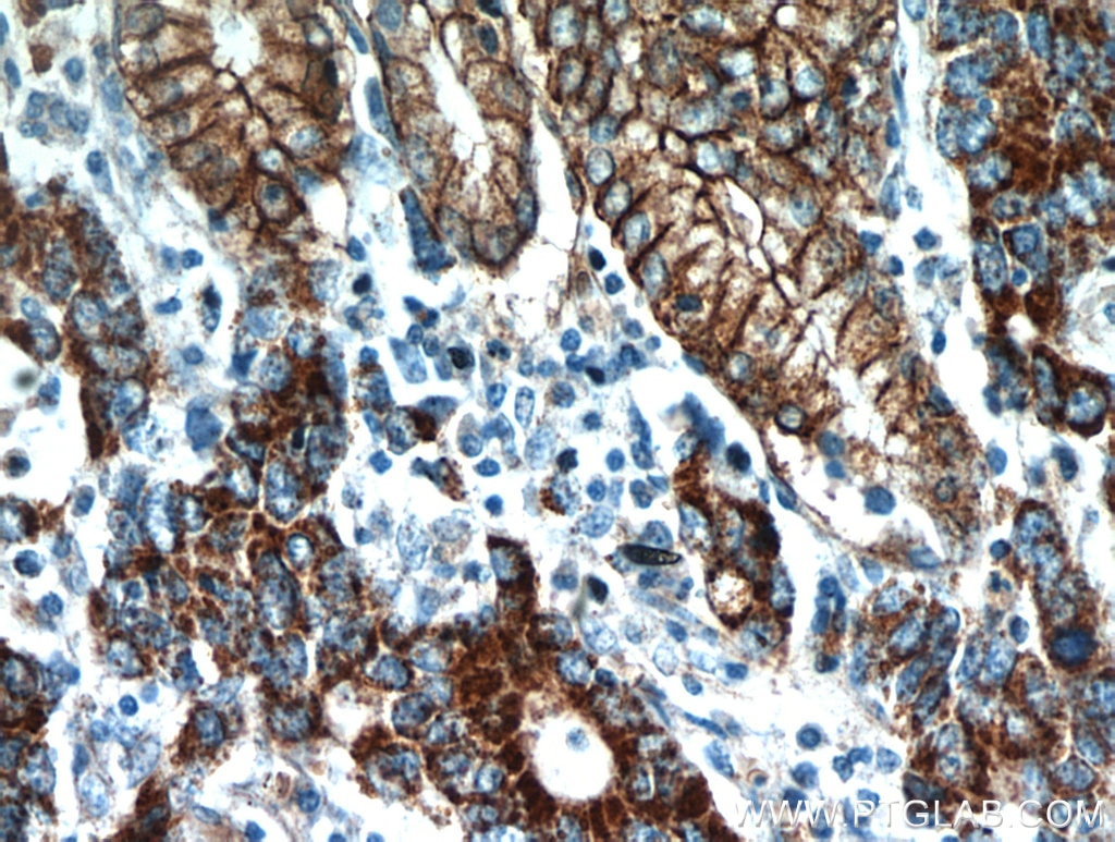 Immunohistochemistry (IHC) staining of human stomach cancer tissue using Claudin 18 Polyclonal antibody (21126-1-AP)