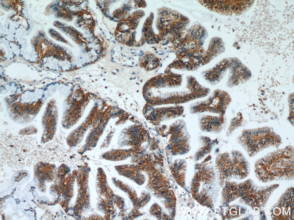 IHC staining of human ovary tumor using 21126-1-AP
