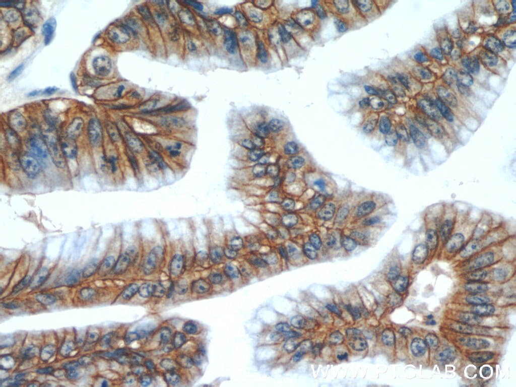 Immunohistochemistry (IHC) staining of human ovary tumor tissue using Claudin 18 Polyclonal antibody (21126-1-AP)