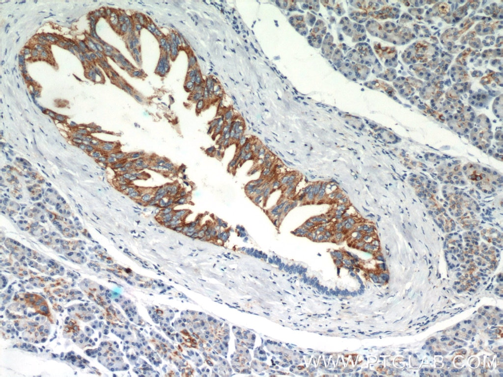 Immunohistochemistry (IHC) staining of human pancreas cancer tissue using Claudin 18 Polyclonal antibody (21126-1-AP)