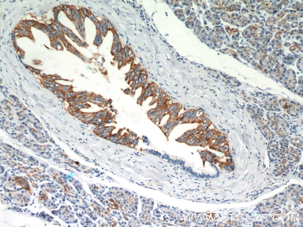 IHC staining of human pancreas cancer using 21126-1-AP