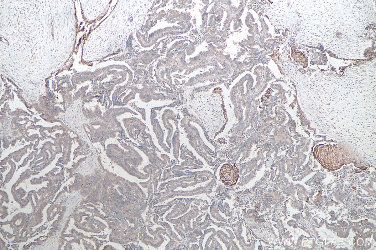 Immunohistochemistry (IHC) staining of human ovary tumor tissue using Claudin 18 Monoclonal antibody (66167-1-Ig)