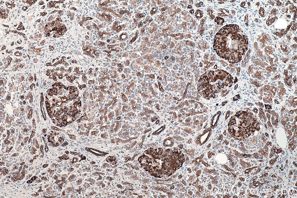 Immunohistochemistry (IHC) staining of human pancreas cancer tissue using Claudin 18 Monoclonal antibody (66167-1-Ig)