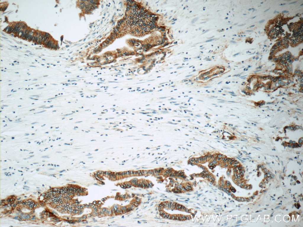 IHC staining of human pancreas cancer using 66167-1-Ig