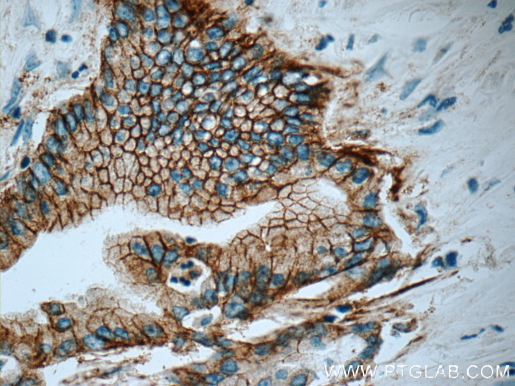 Immunohistochemistry (IHC) staining of human pancreas cancer tissue using Claudin 18 Monoclonal antibody (66167-1-Ig)