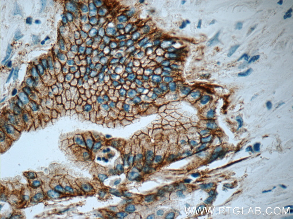 IHC staining of human pancreas cancer using 66167-1-Ig