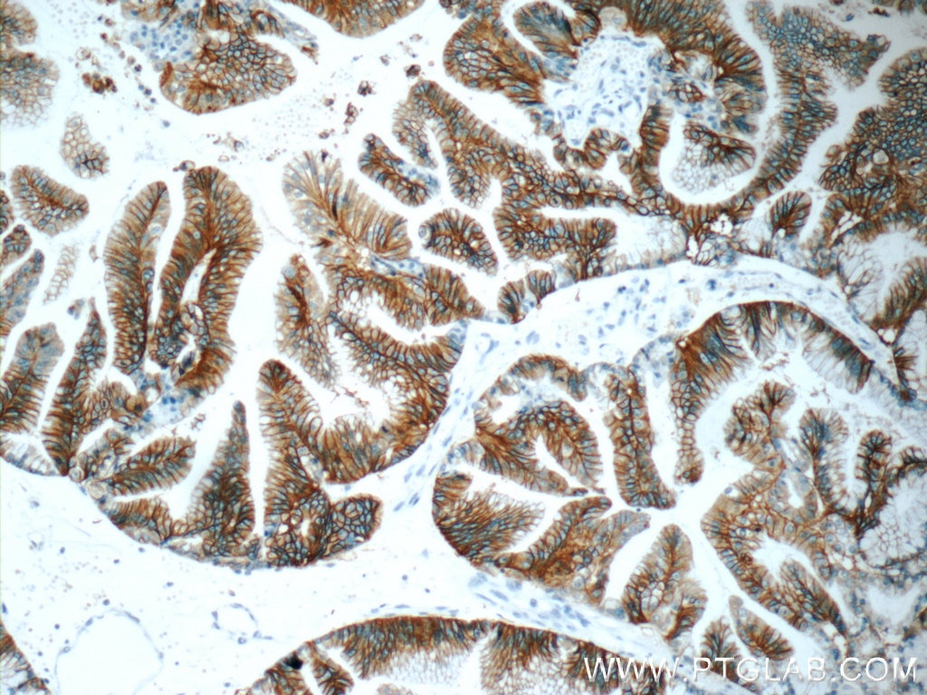 Immunohistochemistry (IHC) staining of human ovary tumor tissue using Claudin 18 Monoclonal antibody (66167-1-Ig)