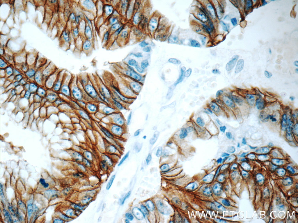 Immunohistochemistry (IHC) staining of human ovary tumor tissue using Claudin 18 Monoclonal antibody (66167-1-Ig)