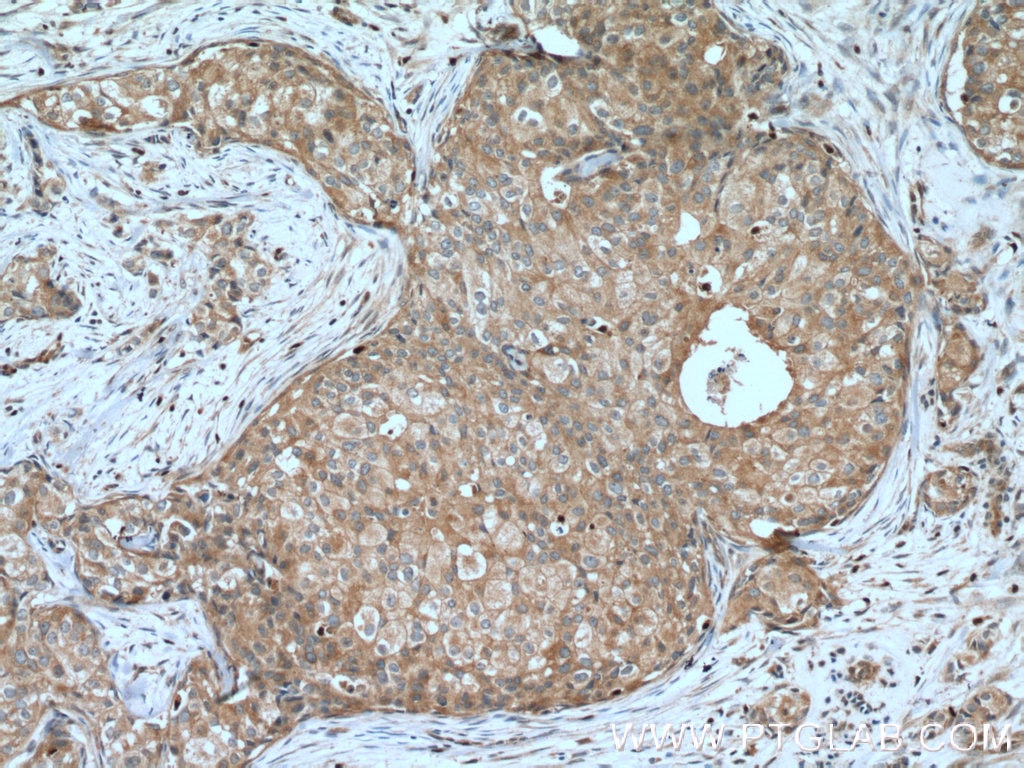 IHC staining of human breast cancer using 16456-1-AP