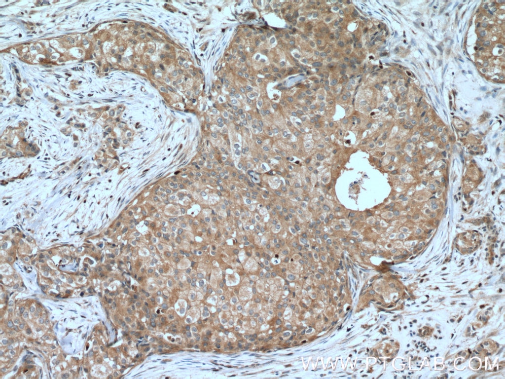 Immunohistochemistry (IHC) staining of human breast cancer tissue using Claudin 3 Polyclonal antibody (16456-1-AP)