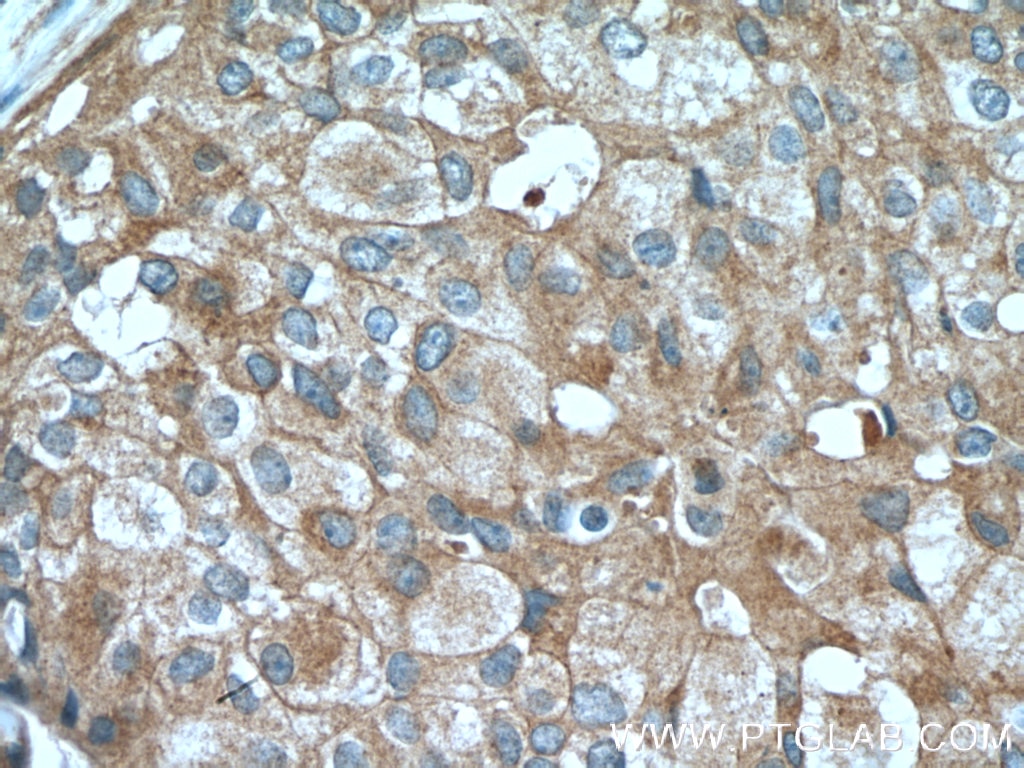Immunohistochemistry (IHC) staining of human breast cancer tissue using Claudin 3 Polyclonal antibody (16456-1-AP)