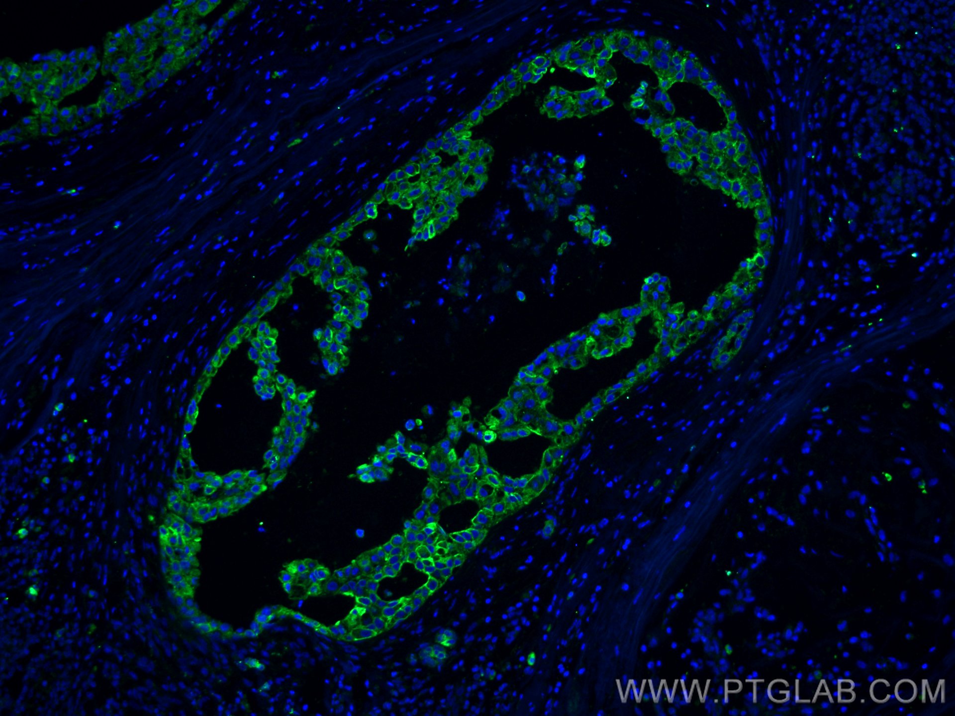 Immunofluorescence (IF) / fluorescent staining of human breast cancer tissue using Claudin 4-specific Polyclonal antibody (16195-1-AP)