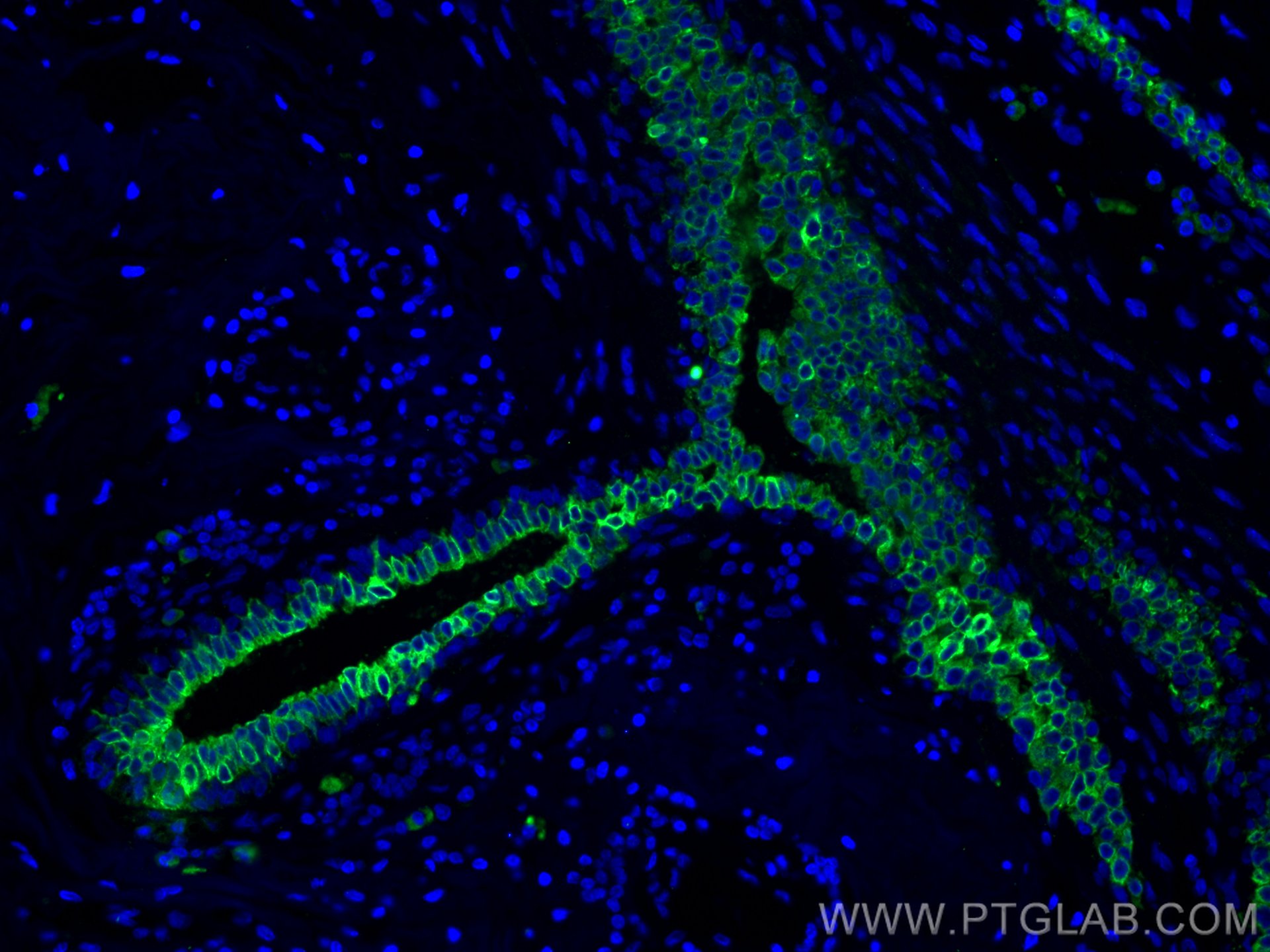 Immunofluorescence (IF) / fluorescent staining of human breast cancer tissue using Claudin 4-specific Polyclonal antibody (16195-1-AP)