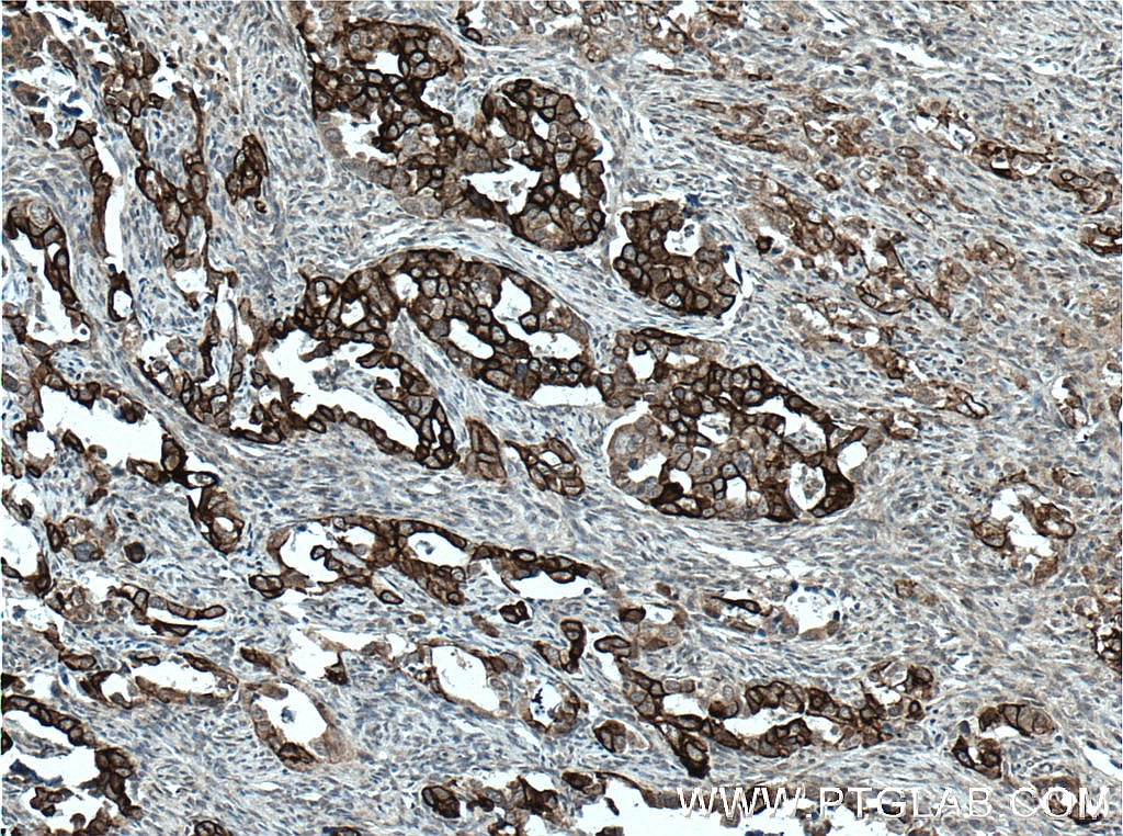 Immunohistochemistry (IHC) staining of human ovary tumor tissue using Claudin 4-specific Polyclonal antibody (16195-1-AP)