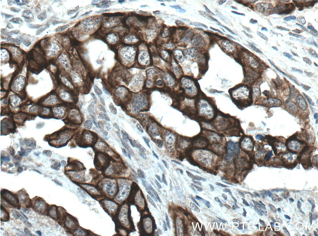 Immunohistochemistry (IHC) staining of human ovary tumor tissue using Claudin 4-specific Polyclonal antibody (16195-1-AP)