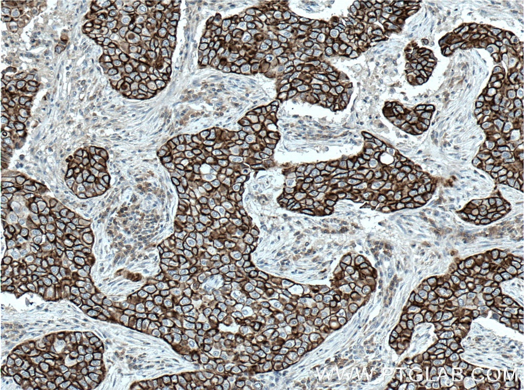 Immunohistochemistry (IHC) staining of human breast cancer tissue using Claudin 4-specific Polyclonal antibody (16195-1-AP)