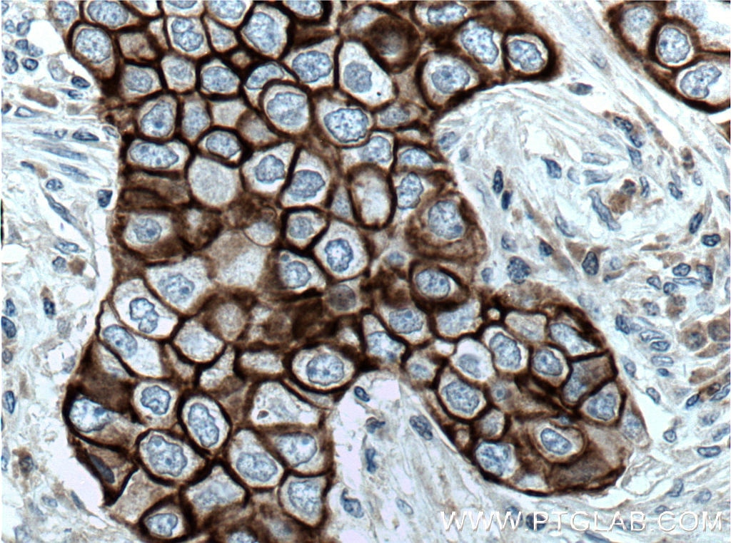 Immunohistochemistry (IHC) staining of human breast cancer tissue using Claudin 4-specific Polyclonal antibody (16195-1-AP)