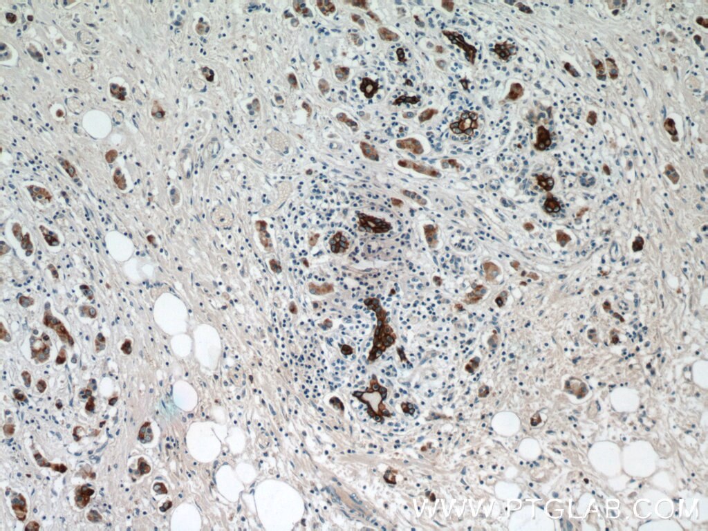 Immunohistochemistry (IHC) staining of human breast cancer tissue using Claudin 4-specific Polyclonal antibody (16195-1-AP)
