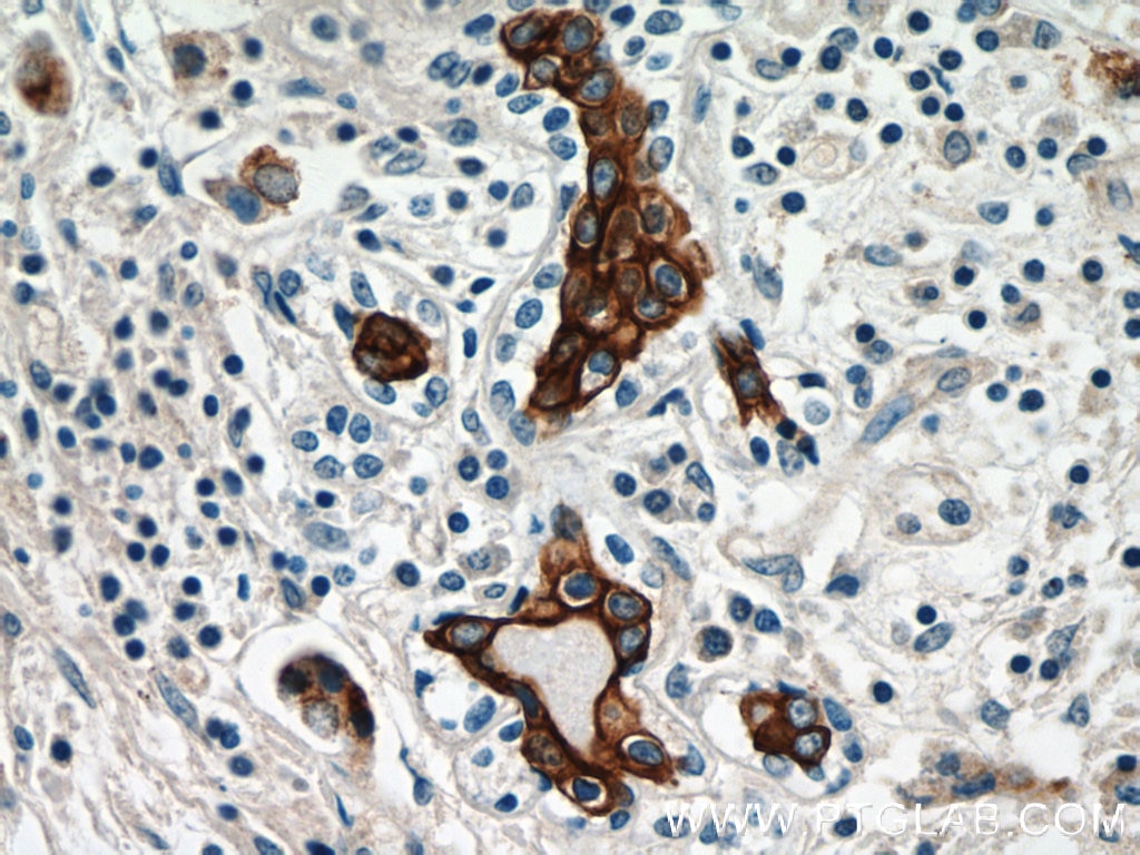 IHC staining of human breast cancer using 16195-1-AP