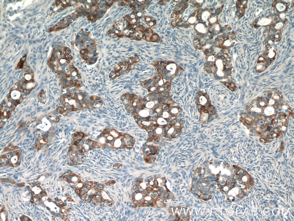 Immunohistochemistry (IHC) staining of human ovary tumor tissue using Claudin 4-specific Polyclonal antibody (16195-1-AP)