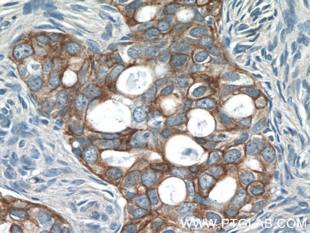 Immunohistochemistry (IHC) staining of human ovary tumor tissue using Claudin 4-specific Polyclonal antibody (16195-1-AP)