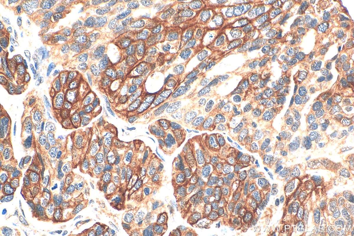 Immunohistochemistry (IHC) staining of human ovary tumor tissue using Claudin 4-specific Polyclonal antibody (16195-1-AP)