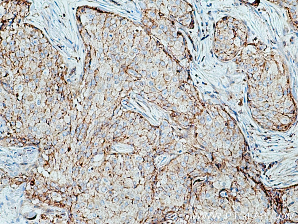 IHC staining of human breast cancer using 10118-1-AP