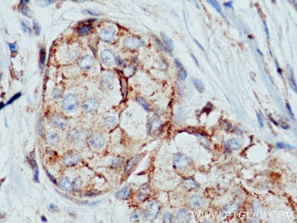 Immunohistochemistry (IHC) staining of human breast cancer tissue using Claudin 7 Polyclonal antibody (10118-1-AP)