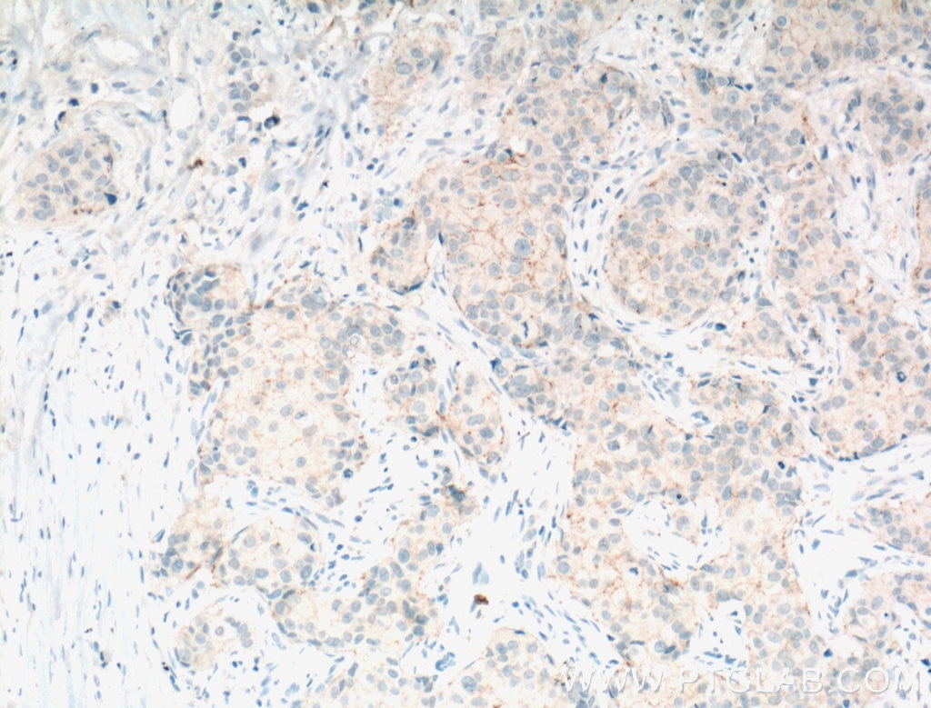 Immunohistochemistry (IHC) staining of human breast cancer tissue using Claudin 7 Polyclonal antibody (10118-1-AP)