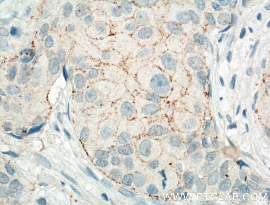 Immunohistochemistry (IHC) staining of human breast cancer tissue using Claudin 7 Polyclonal antibody (10118-1-AP)