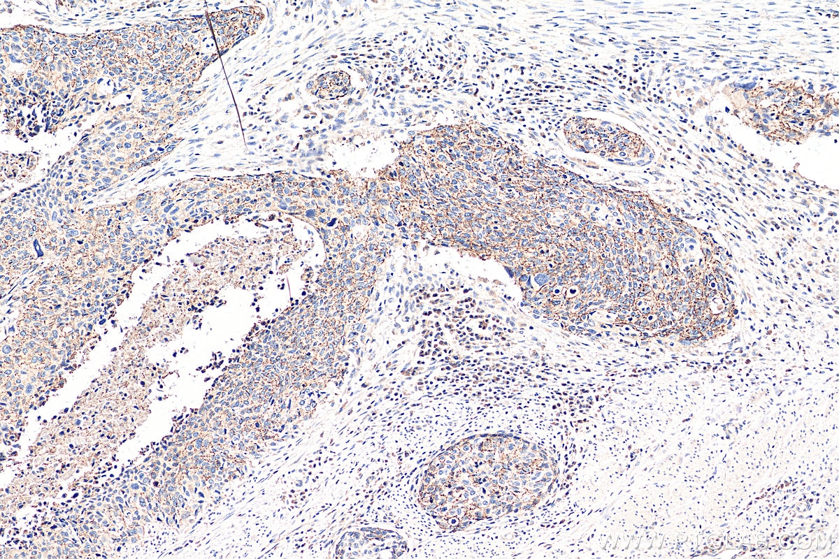 Immunohistochemistry (IHC) staining of human oesophagus cancer tissue using Claudin 7 Polyclonal antibody (29795-1-AP)